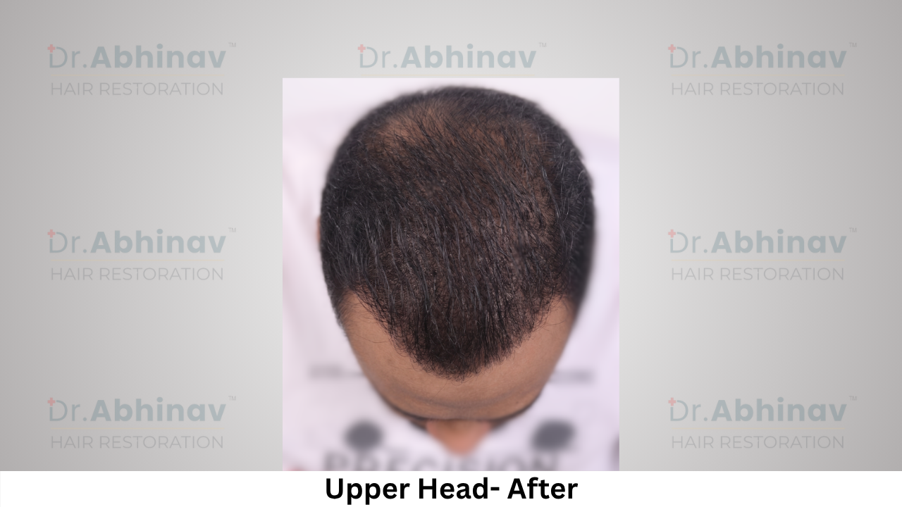 Abhinav Prakash Hair Transplant Upper Head View after - Patna