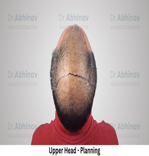 Abhinav Prakash Hair Transplant Upper Head View Planning - Patna