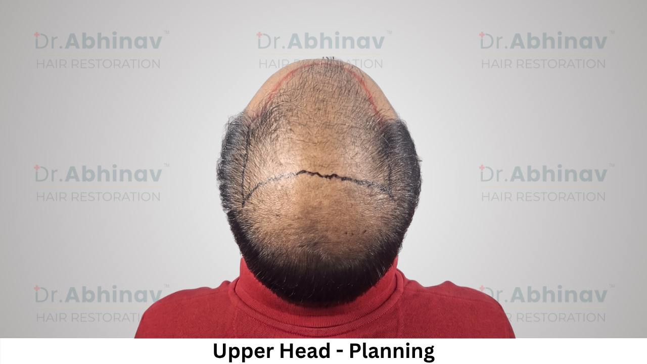 Abhinav Prakash Hair Transplant Upper Head View Planning - Patna