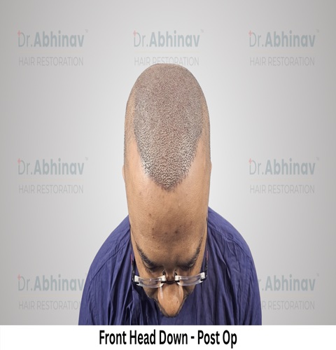 Abhinav Prakash Hair Transplant Front Head Down View Post Op - Patna