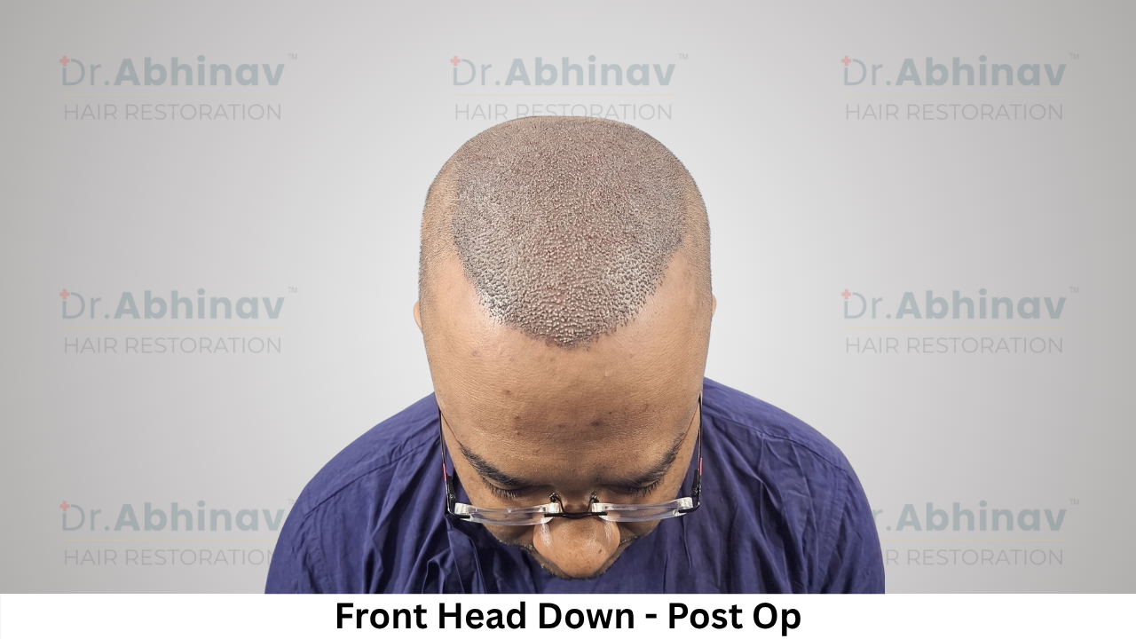Abhinav Prakash Hair Transplant Front Head Down View Post Op - Patna