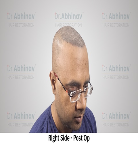 Abhinav Prakash Hair Transplant Right Side View Post Op - Patna