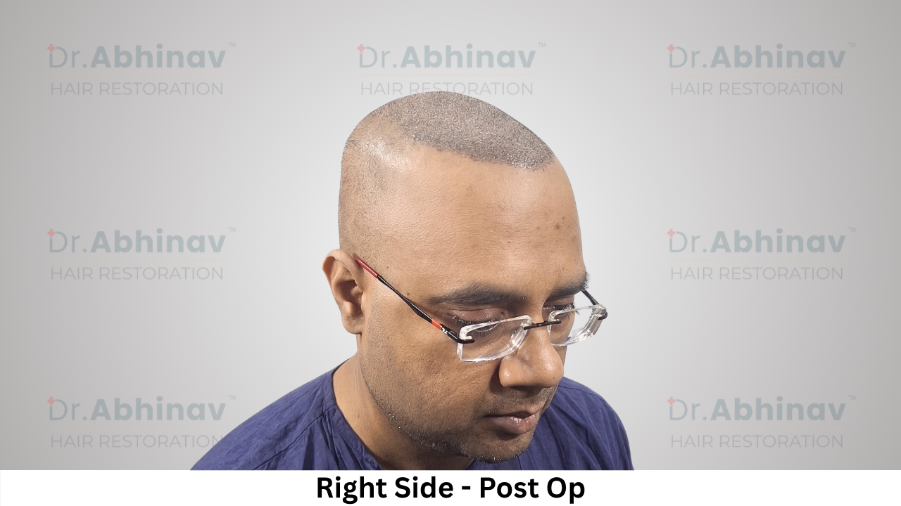 Abhinav Prakash Hair Transplant Right Side View Post Op - Patna