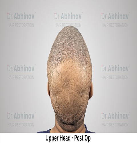 Abhinav Prakash Hair Transplant Upper Head View Post Op - Patna