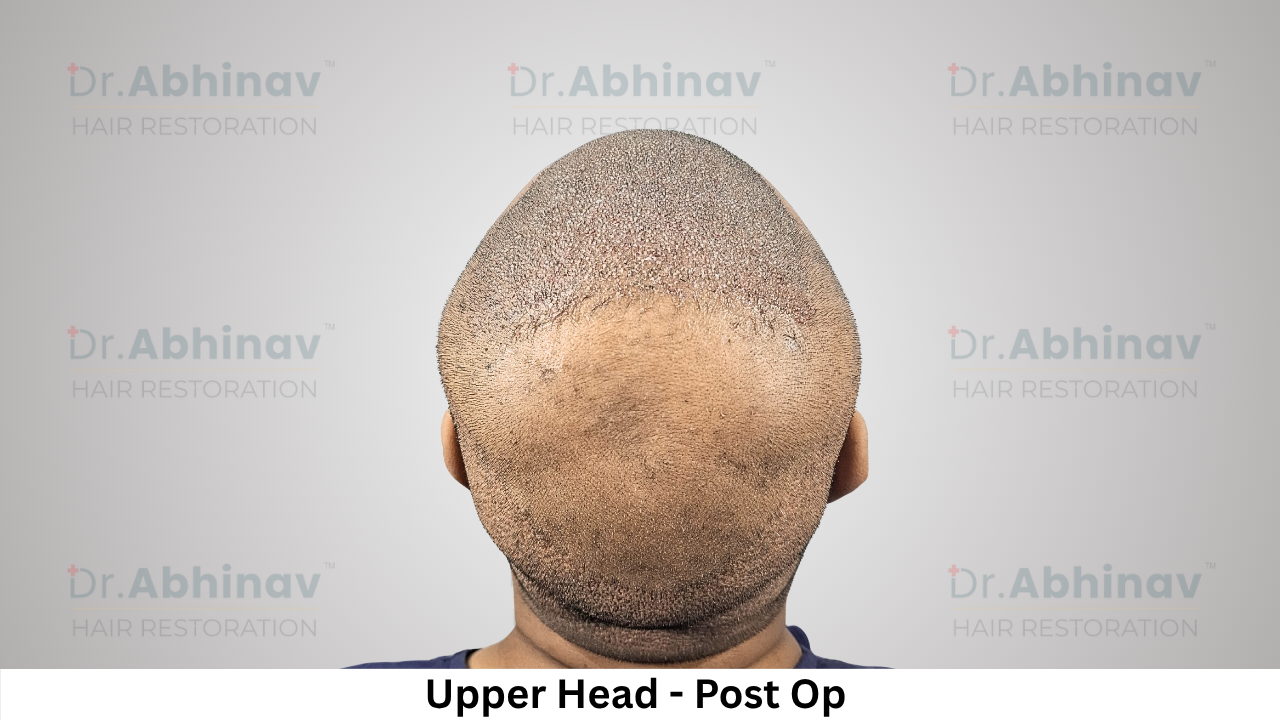 Abhinav Prakash Hair Transplant Upper Head View Post Op - Patna