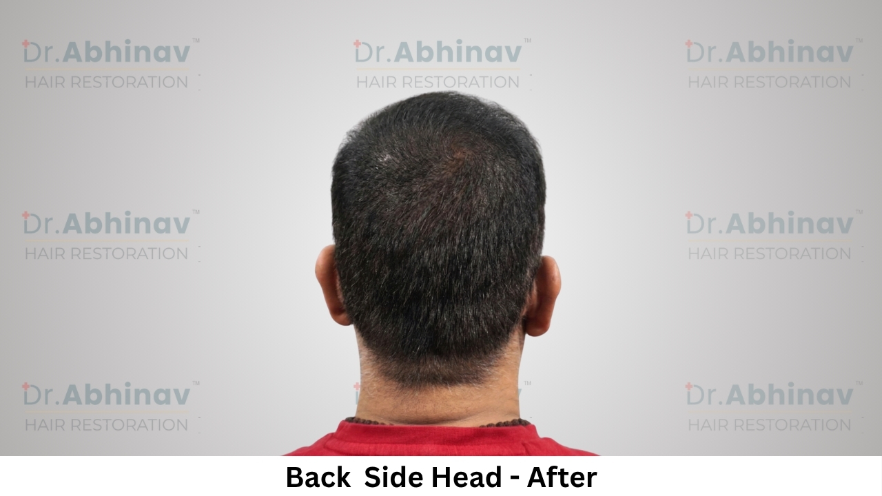 Anil Kumar Hair Transplant Back Side Head View After - Patna