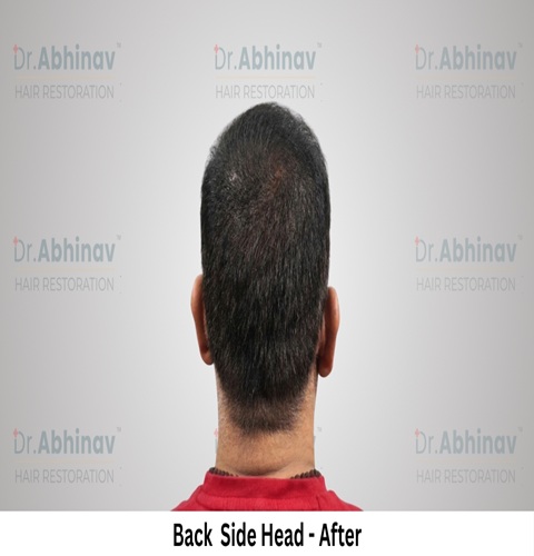 Anil Kumar Hair Transplant Back Side Head View After - Patna
