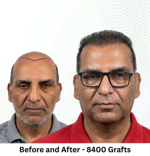 Anil Kumar Hair Transplant Before and After Result - Patna