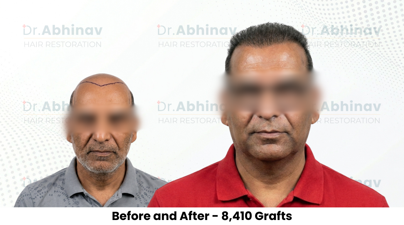 Anil Kumar Hair Transplant Before and After Result - Patna