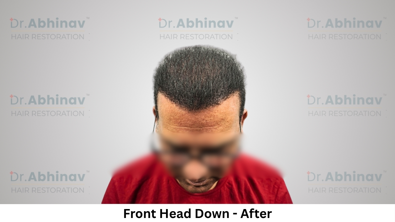 Anil Kumar Hair Transplant Front Head Down View After - Patna