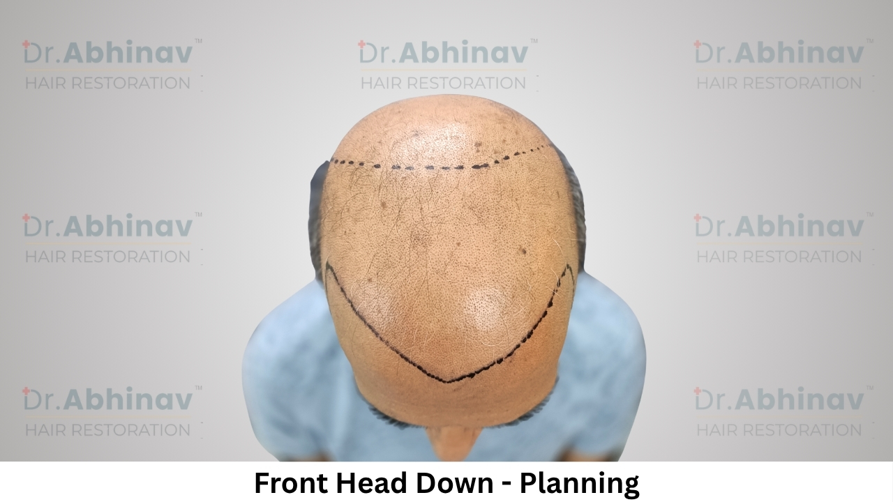Anil Kumar Hair Transplant Front Head Down View Planning - Patna