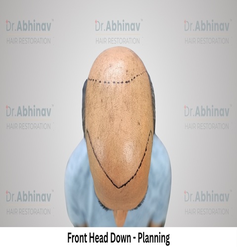 Anil Kumar Hair Transplant Front Head Down View Planning - Patna