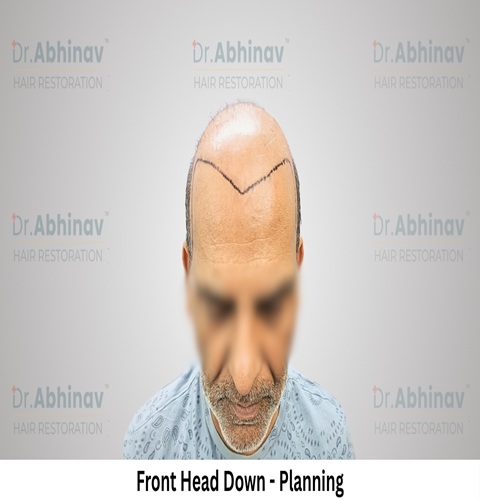 Anil Kumar Hair Transplant Front Head Down View Planning - Patna