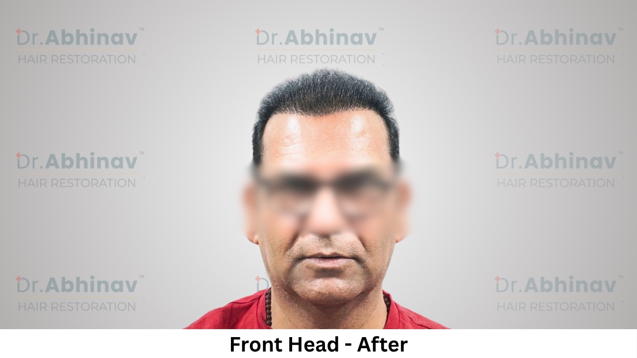 Anil Kumar Hair Transplant Front Head View After - Patna