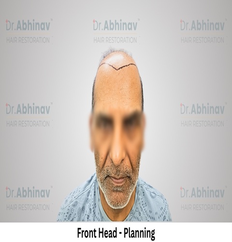 Anil Kumar Hair Transplant Front Head View Planning - Patna