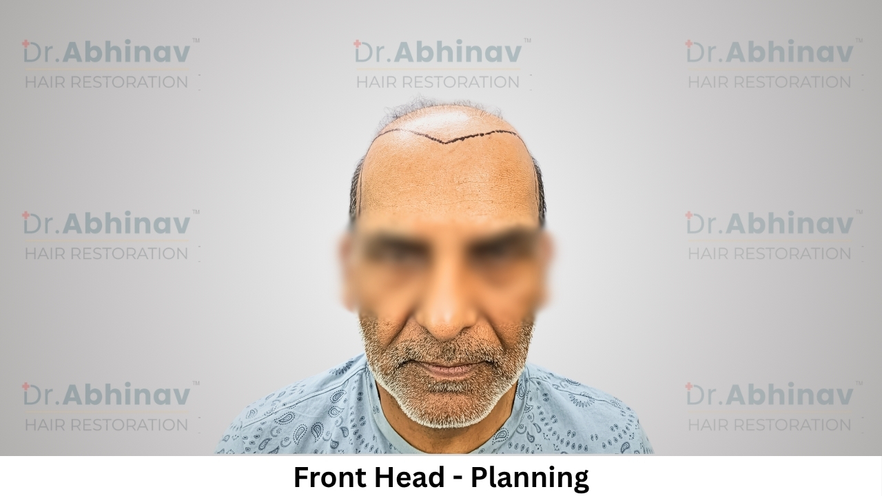 Anil Kumar Hair Transplant Front Head View Planning - Patna