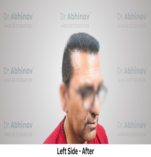 Anil Kumar Hair Transplant Left Side View After - Patna