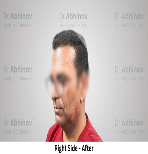 Anil Kumar Hair Transplant Right Side View After - Patna