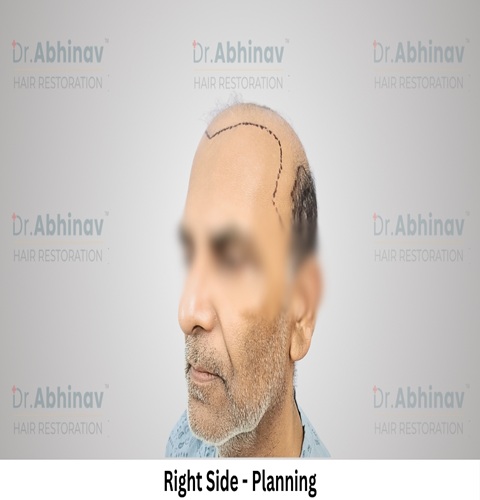 Anil Kumar Hair Transplant Right Side View Planning - Patna