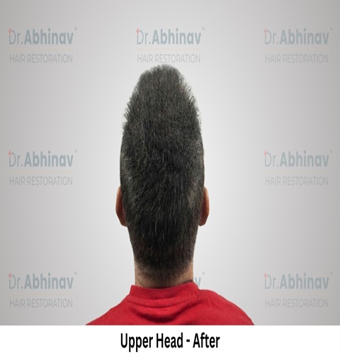 Anil Kumar Hair Transplant Upper Head View After - Patna