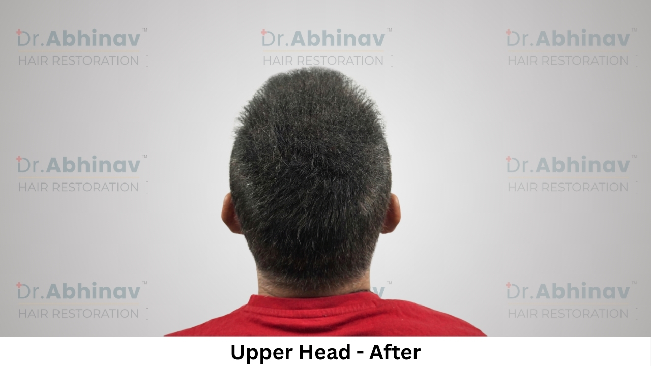 Anil Kumar Hair Transplant Upper Head View After - Patna