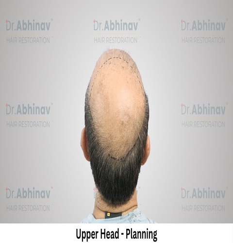 Anil Kumar Hair Transplant Upper Head View Planning - Patna