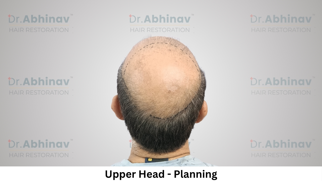 Anil Kumar Hair Transplant Upper Head View Planning - Patna