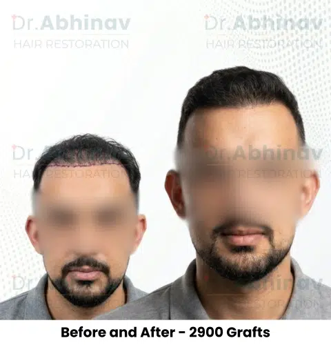 Anthony Truffer Hair Transplant Before and After Result - Patna