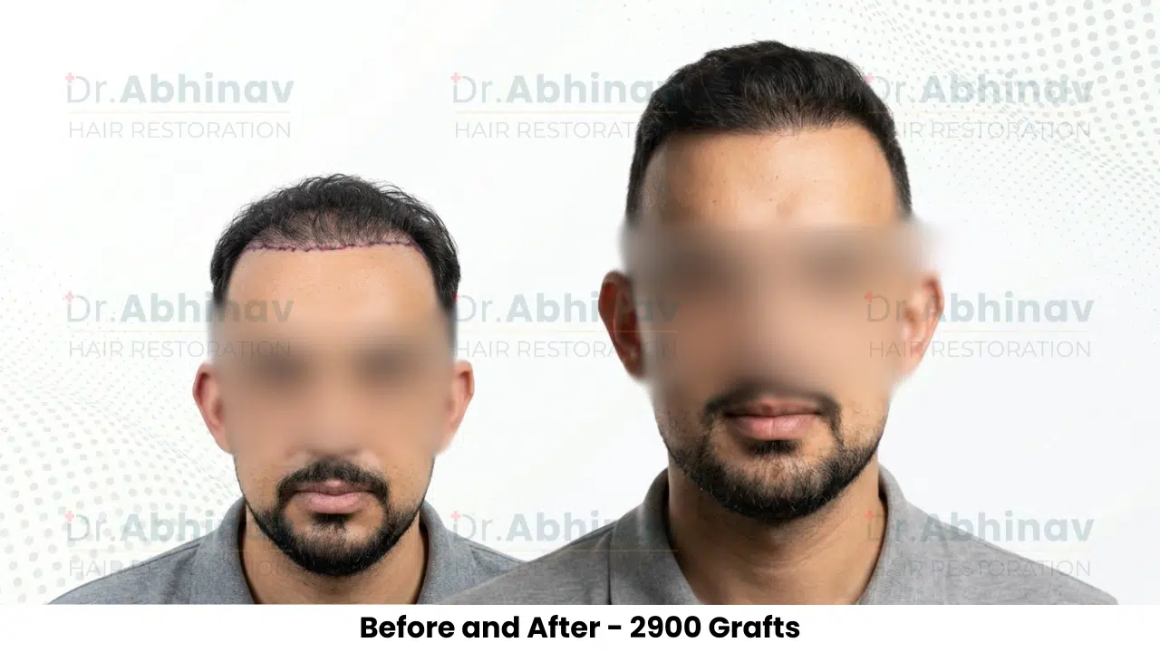 Anthony Truffer Hair Transplant Before and After Result - Patna