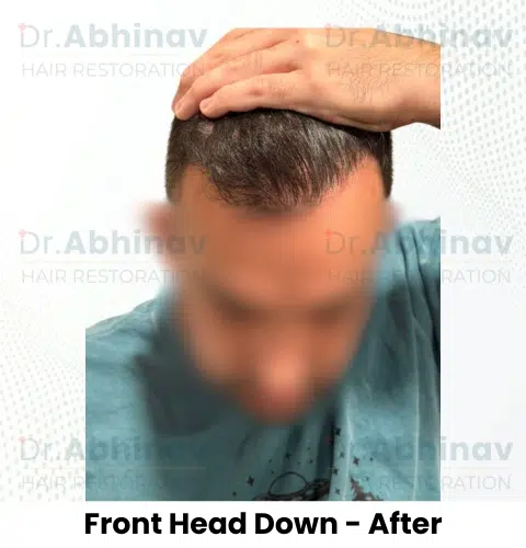Anthony Truffer Hair Transplant Front Head Down View After - Patna