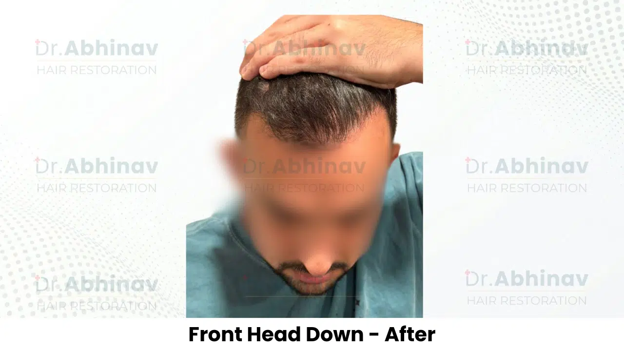 Anthony Truffer Hair Transplant Front Head Down View After - Patna