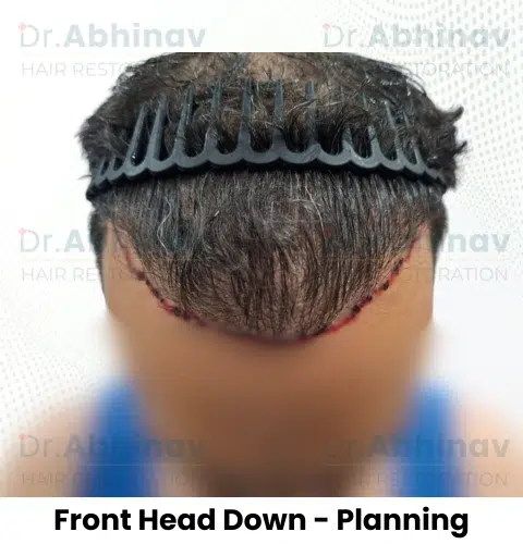 Anthony Truffer Hair Transplant Front Head Down View Planning - Patna