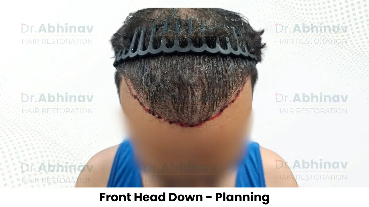 Anthony Truffer Hair Transplant Front Head Down View Planning - Patna