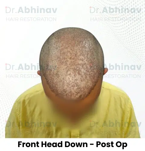 Anthony Truffer Hair Transplant Front Head Down View Post Op - Patna