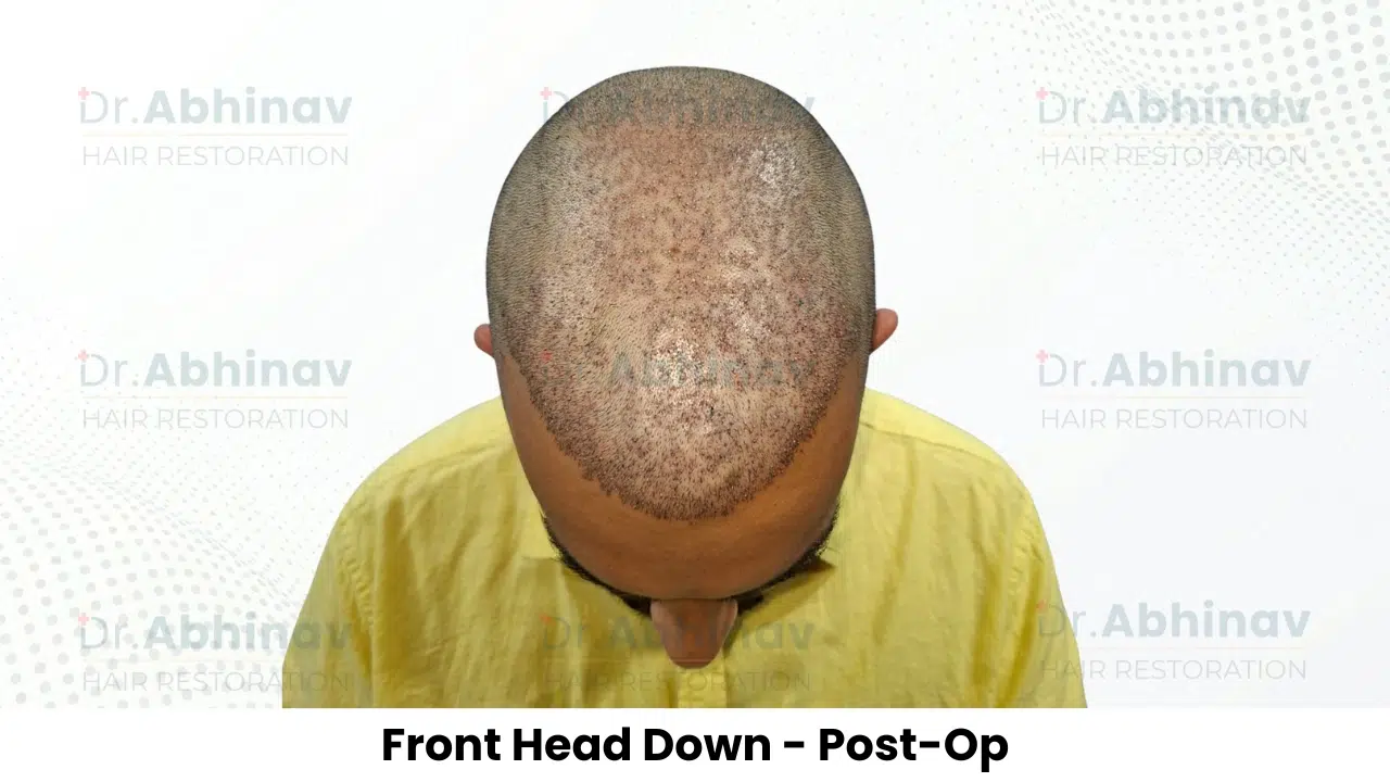 Anthony Truffer Hair Transplant Front Head Down View Post Op - Patna