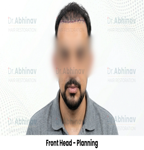Anthony Truffer Hair Transplant Front Head View Planning - Patna