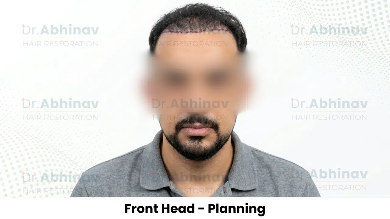 Anthony Truffer Hair Transplant Front Head View Planning - Patna
