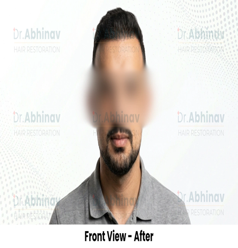 Anthony Truffer Hair Transplant Front Head View After - Patna