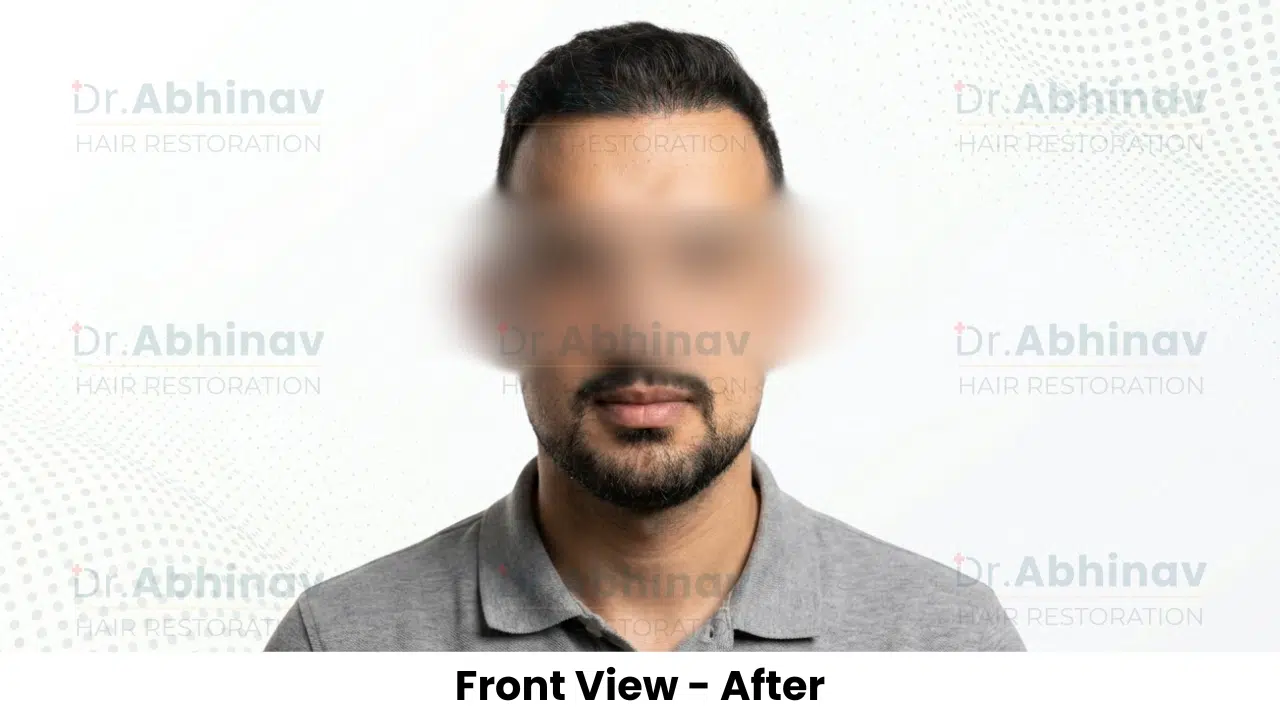 Anthony Truffer Hair Transplant Front Head View After - Patna