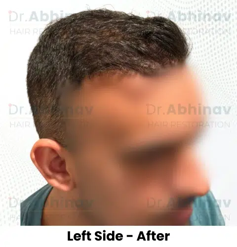 Anthony Truffer Hair Transplant Left Side View After - Patna