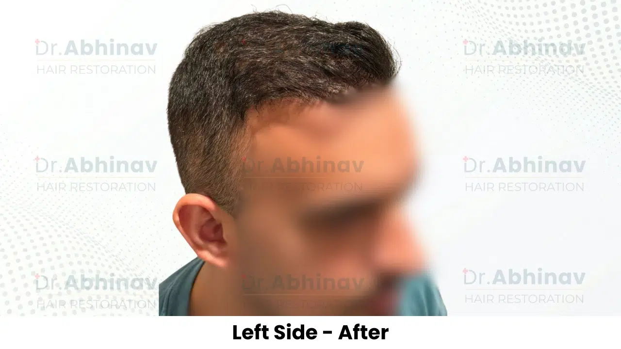 Anthony Truffer Hair Transplant Left Side View After - Patna