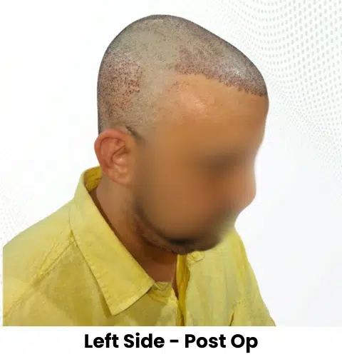 Anthony Truffer Hair Transplant Left Side View Post Op - Patna