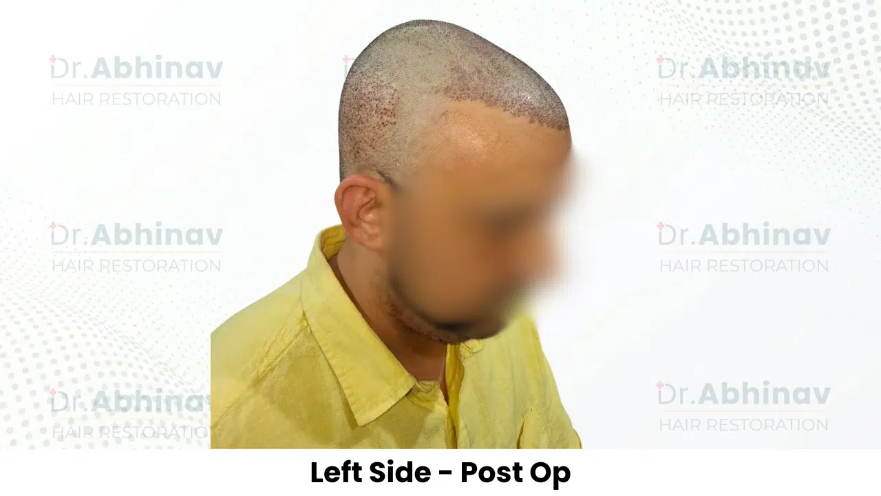 Anthony Truffer Hair Transplant Left Side View Post Op - Patna