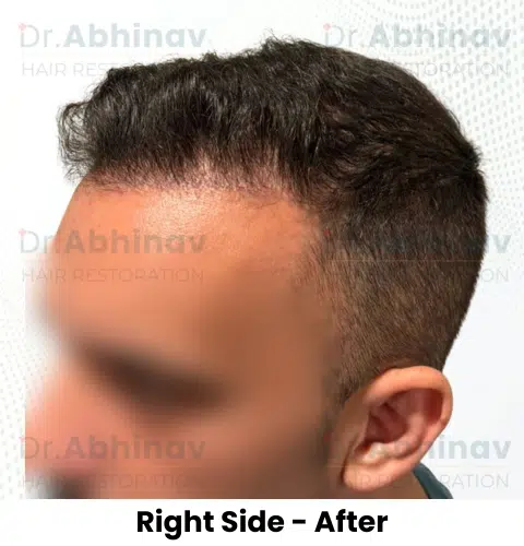Anthony Truffer Hair Transplant Right Side View After - Patna