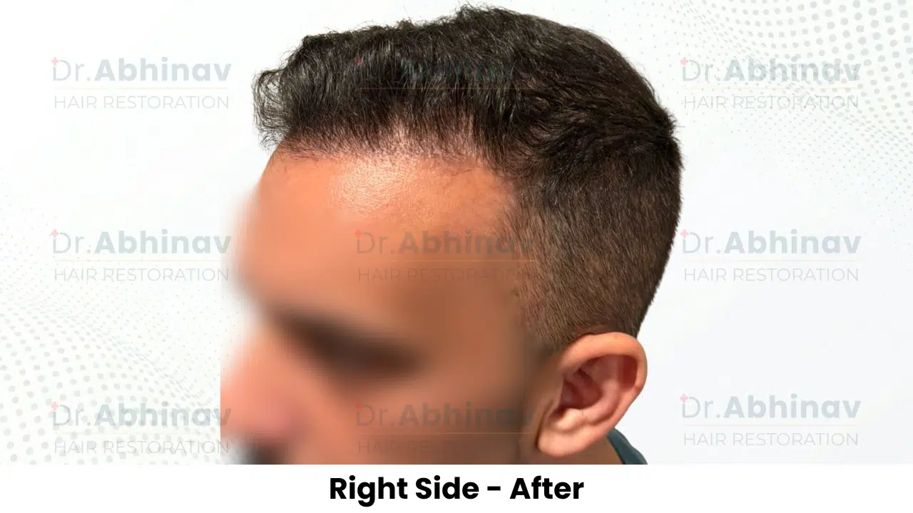 Anthony Truffer Hair Transplant Right Side View After - Patna