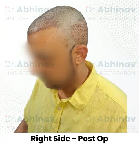 Anthony Truffer Hair Transplant Right Side View Post Op - Patna
