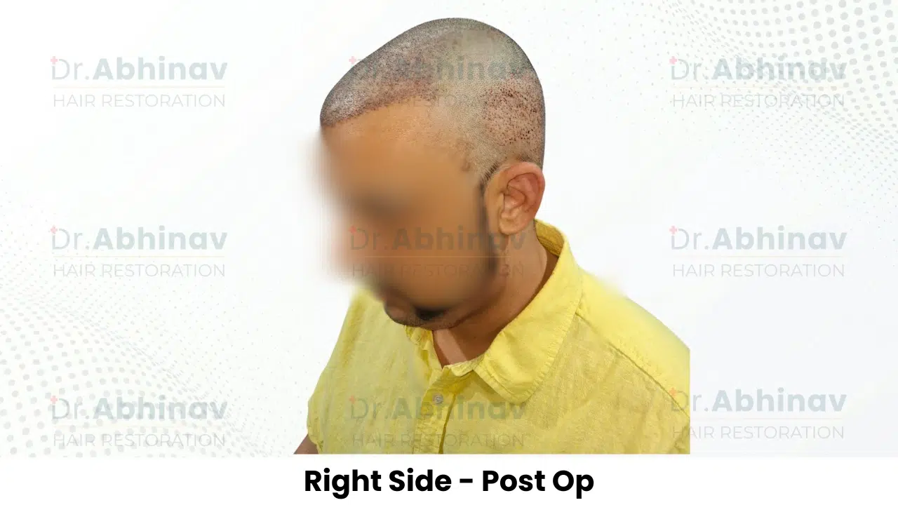 Anthony Truffer Hair Transplant Right Side View Post Op - Patna