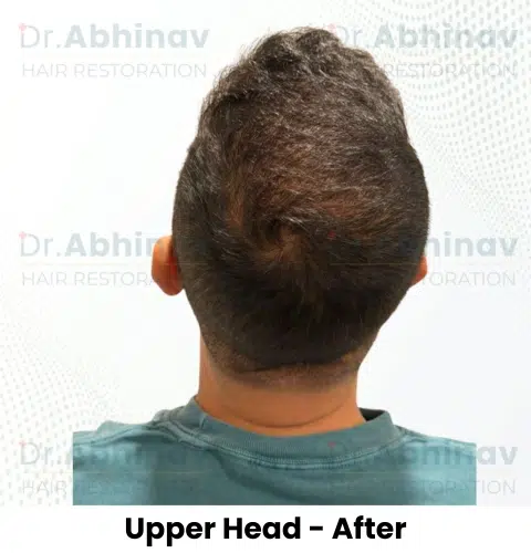 Anthony Truffer Hair Transplant Upper Head View After - Patna