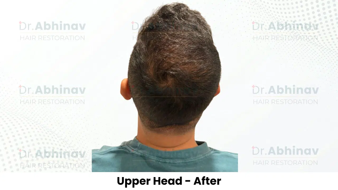 Anthony Truffer Hair Transplant Upper Head View After - Patna