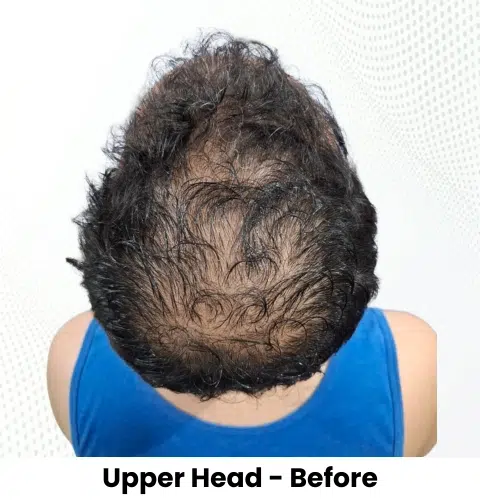 Anthony Truffer Hair Transplant Upper Head View Before - Patna